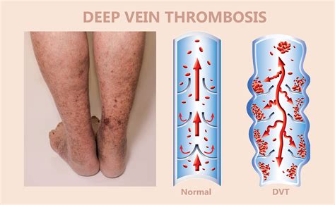Deep vein thrombosis (DVT) .
